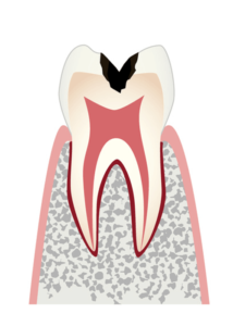 【C2】歯の内部まで進行した虫歯